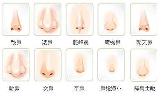 郑东学鼻子术后果