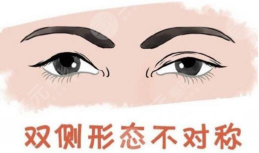 郑州辰星双眼皮手术术后果