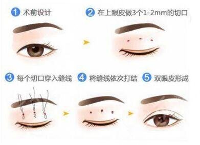 不能做双眼皮的眼睛图