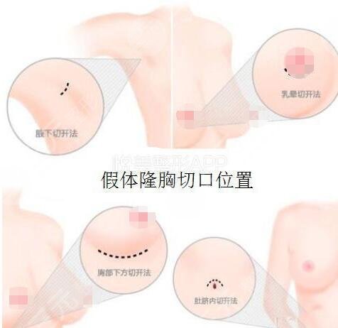 自体脂肪丰胸案例