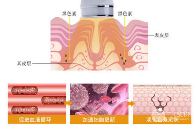[经验]光子嫩肤去痘果别期望太高，还是治疗红血丝强！