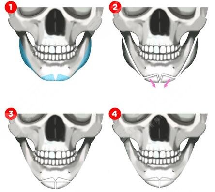 下颌角整形术全过程详细揭秘,下颌角手术改脸型果理想吗?