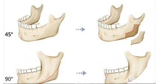 下颌角整形术全过程