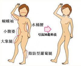 可吸脂的部位