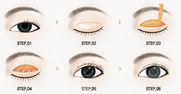双眼皮实例