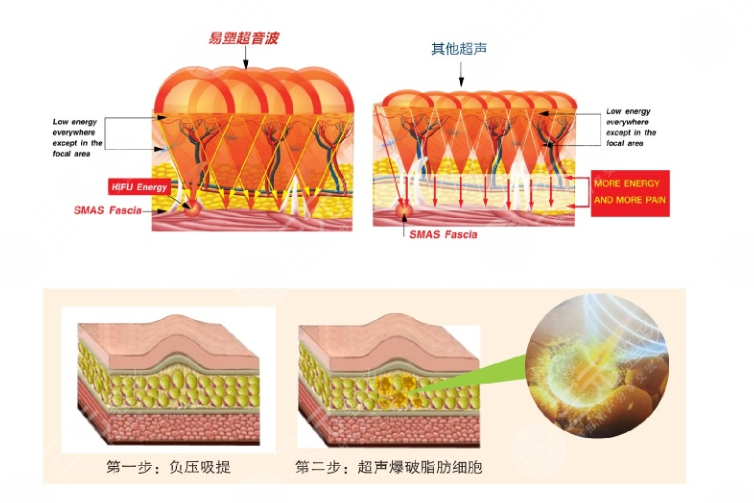 超脂塑溶脂的费用是多少呢