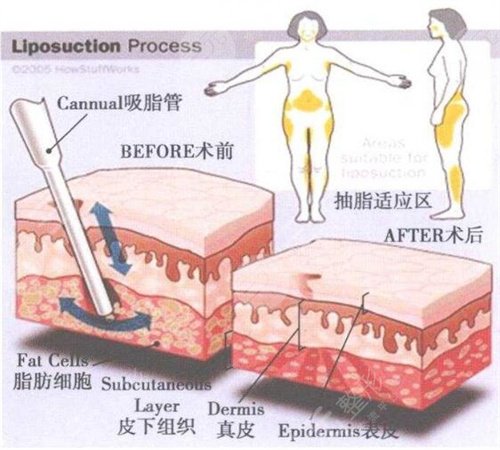 瘦腰后