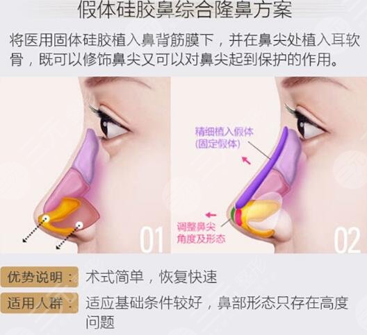隆鼻术简介