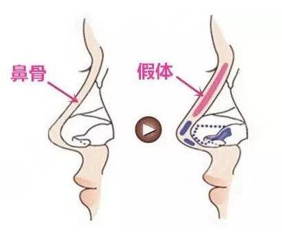 隆鼻术后的各种图片