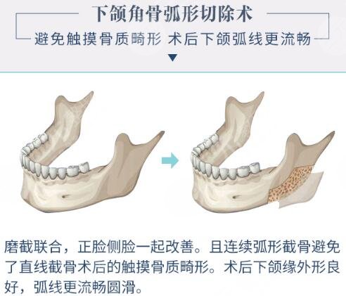 削骨手术哪里好 科普