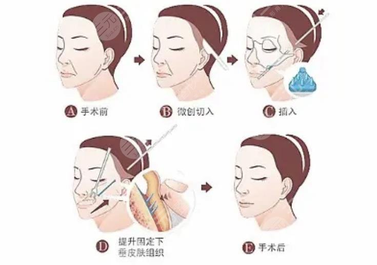 拉皮手术