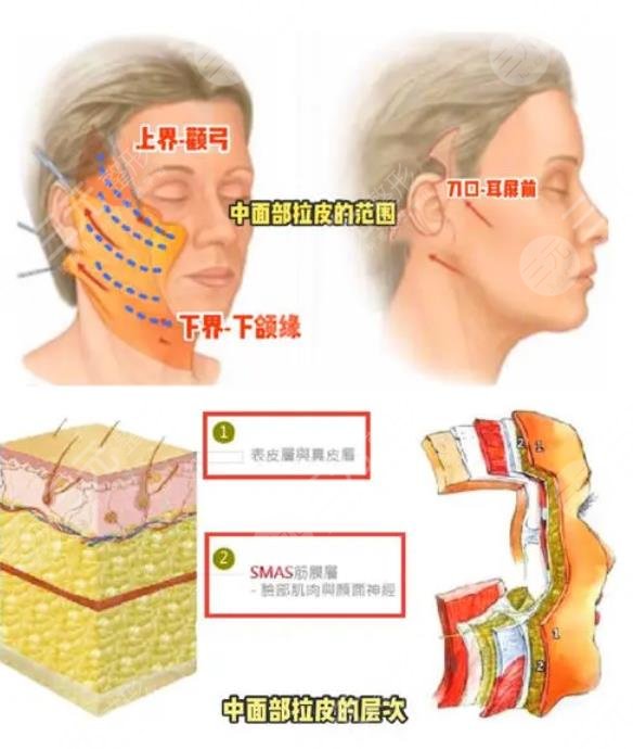 小切口拉皮除皱