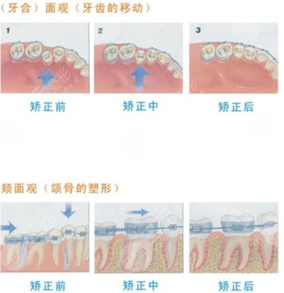 牙齿矫正的原理