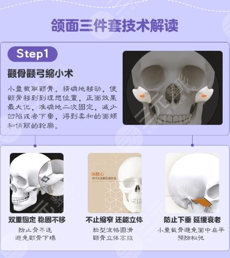 下颌角整形原理