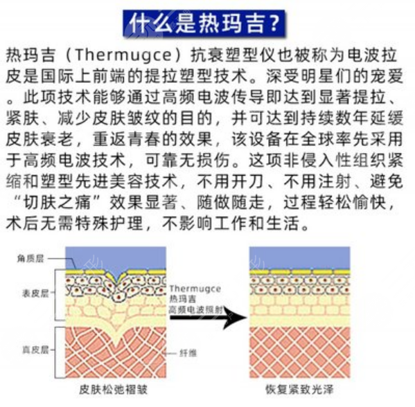 做热玛吉一次能保持多久
