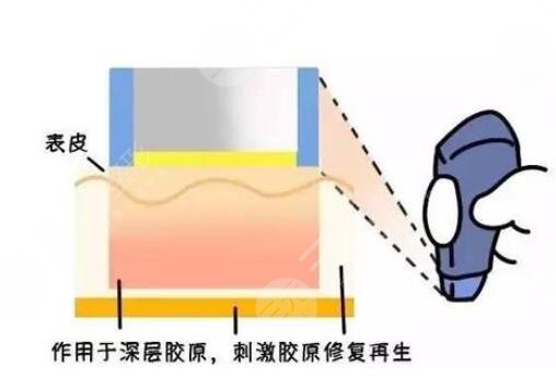 热玛吉价格