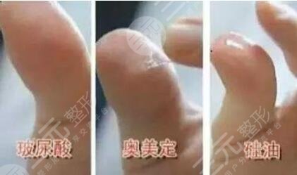 取奥美定术后注意事项