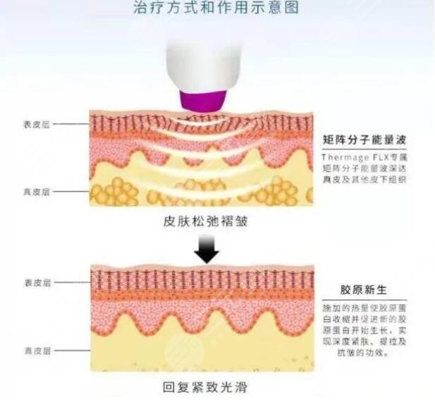 热玛吉治疗的原理