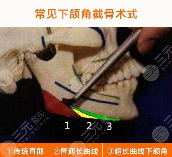 改脸型手术原理