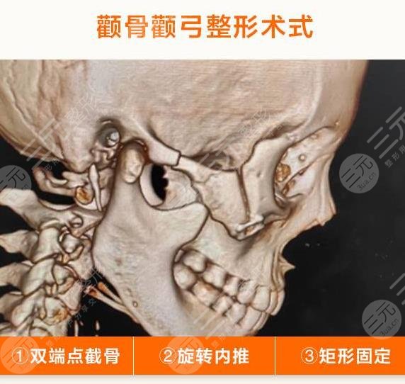 改脸型手术原理