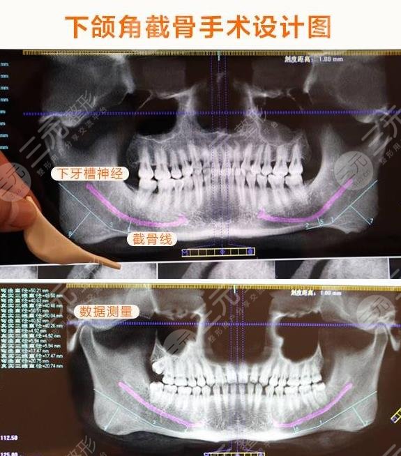 改脸型手术原理