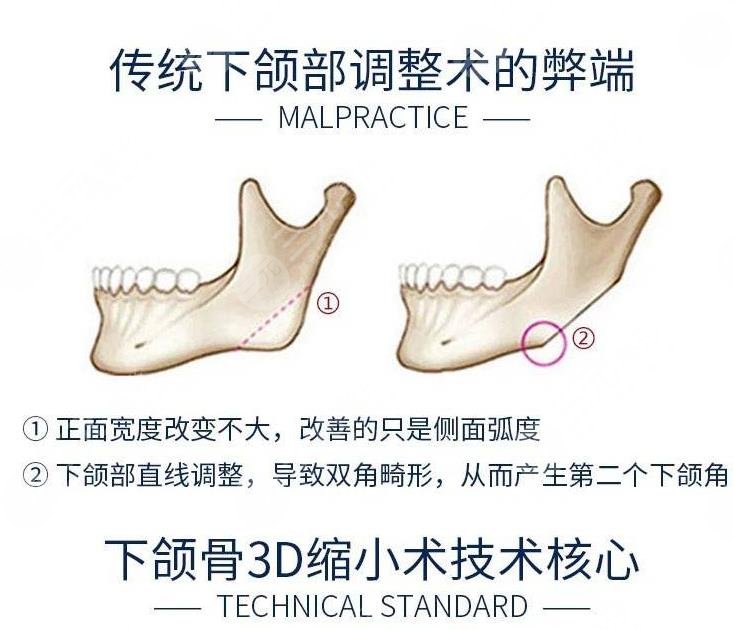 改脸型手术