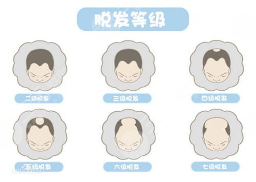 贾乃亮双12赞助员工植发