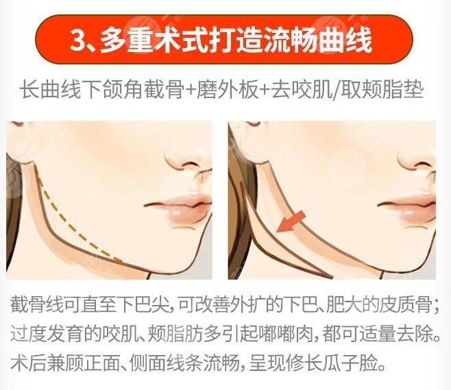 上海下颌角整形