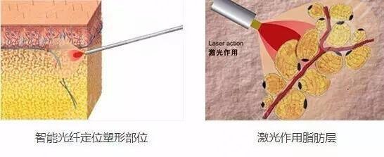 光纤溶脂