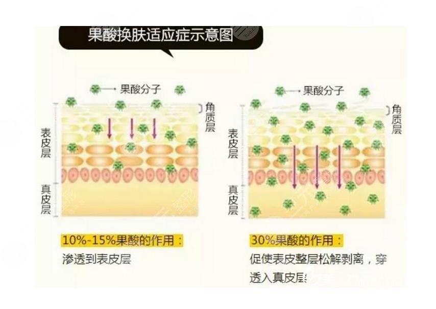 果酸换肤是什么原理?