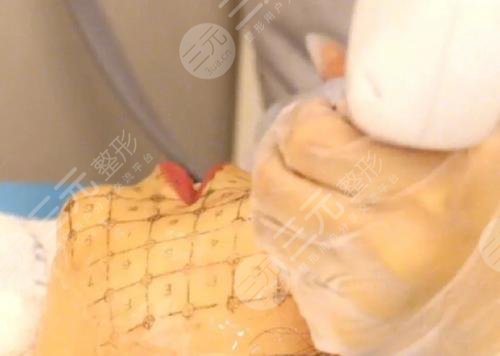 热玛吉术后注意事项