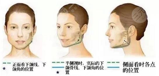 李志海颧骨内推案例对比图