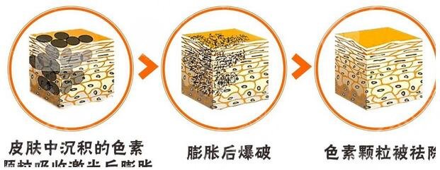 激光祛斑案例