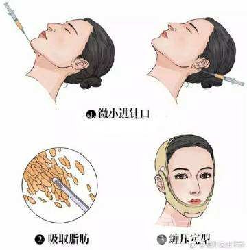 面部吸脂手术