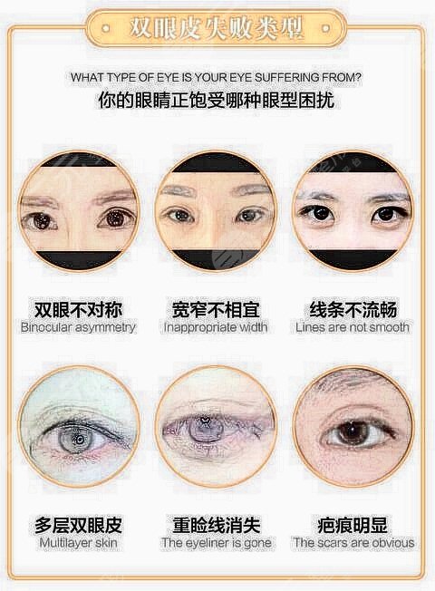 术后58天