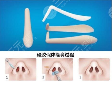 巫文云隆鼻术后果图