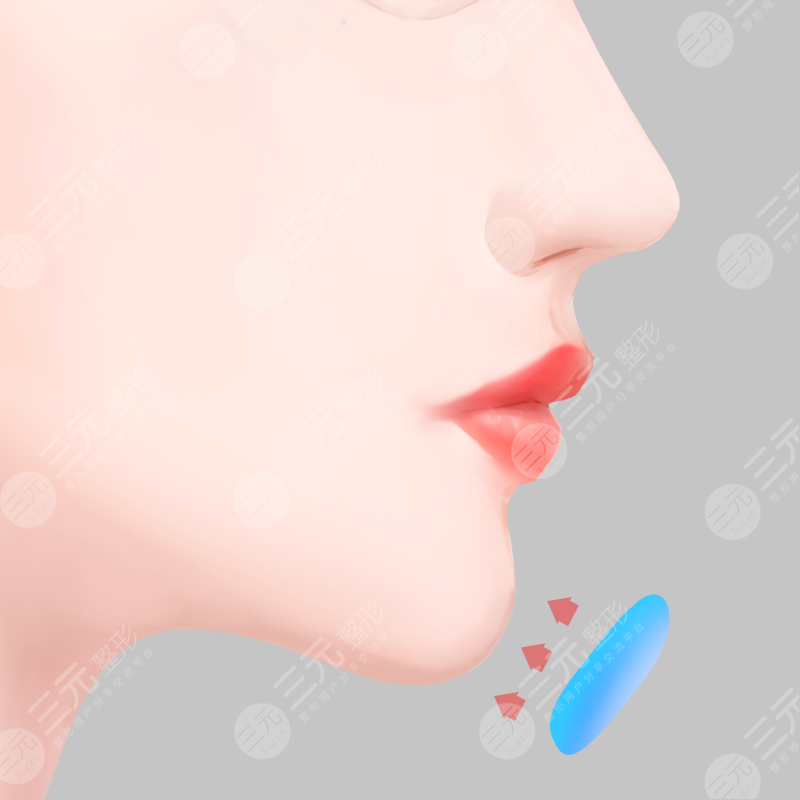 上海首尔丽格磨骨案例