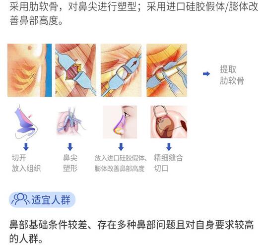 武汉肋骨鼻专家汪福强医生科普