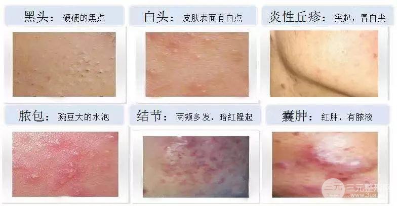 痤疮的严重程度