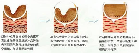 点阵激光祛痘