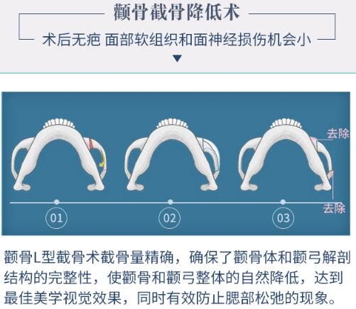 上海整形医生排名前三的何晋龙科普颧骨手术