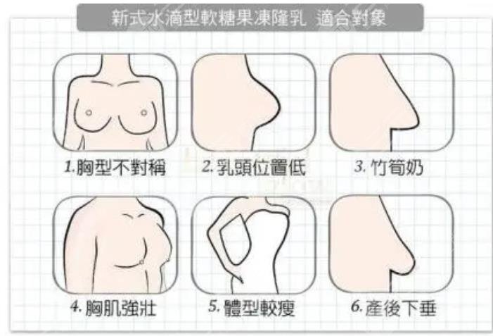 硅胶隆胸的技术特点