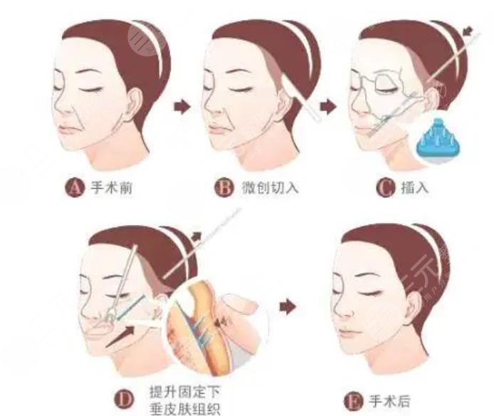 拉皮除皱