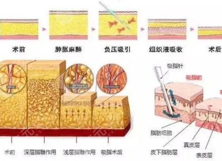 吸脂手术的优缺点