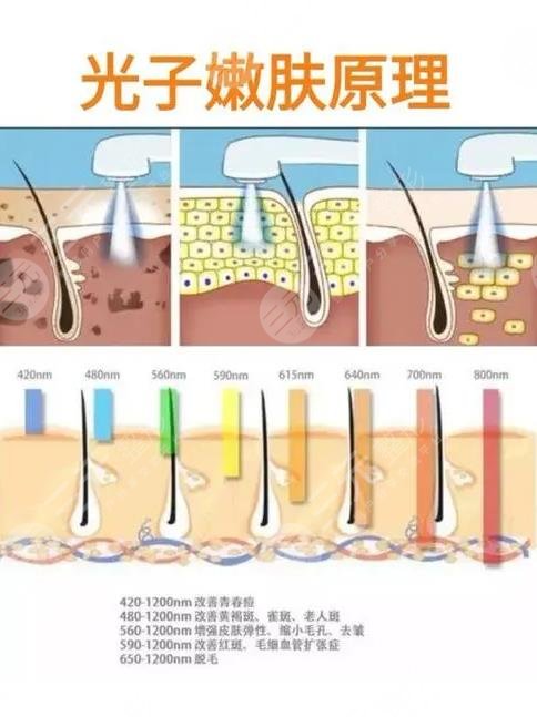 光子嫩肤原理