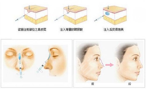面部凹陷