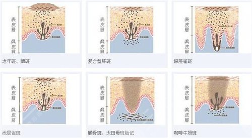北医三院激光祛斑案例：术后15天