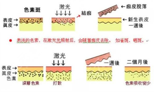 北医三院激光祛斑真实案例：术后2个月