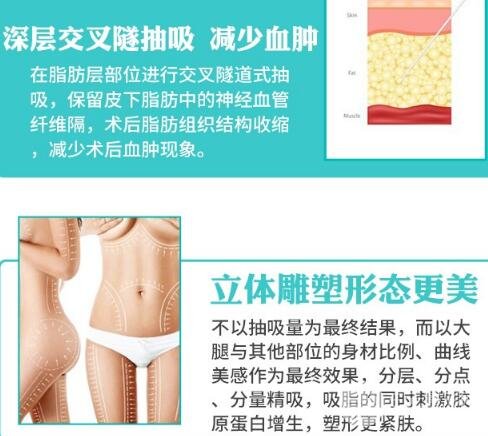 吸脂体雕