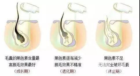 脱毛原理